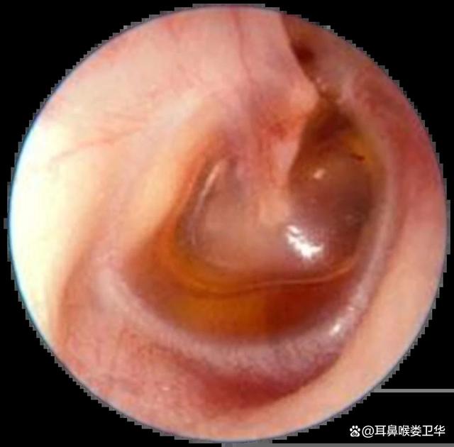 急性化脓性中耳炎是什么病