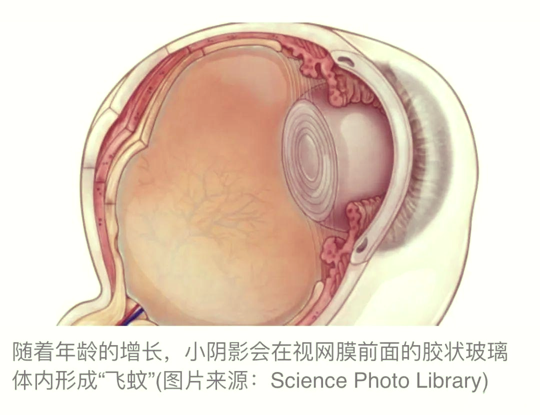 眼睛飞蚊症能自愈吗