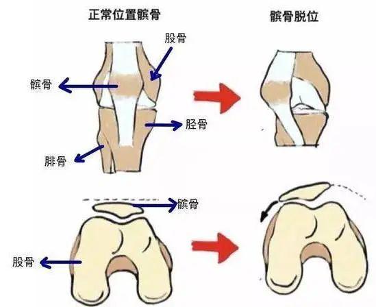 髌骨在哪里