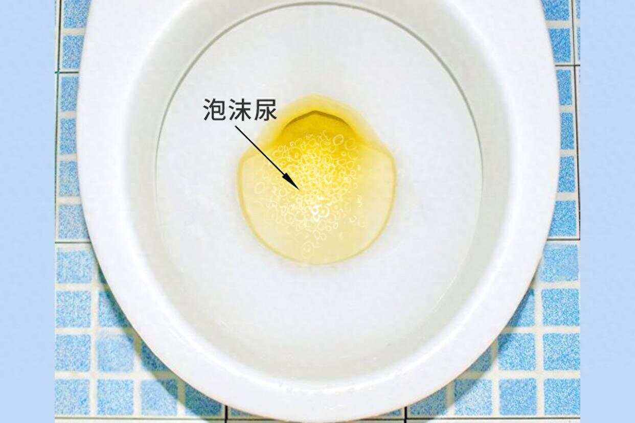 小便发黄,有泡沫是怎么了