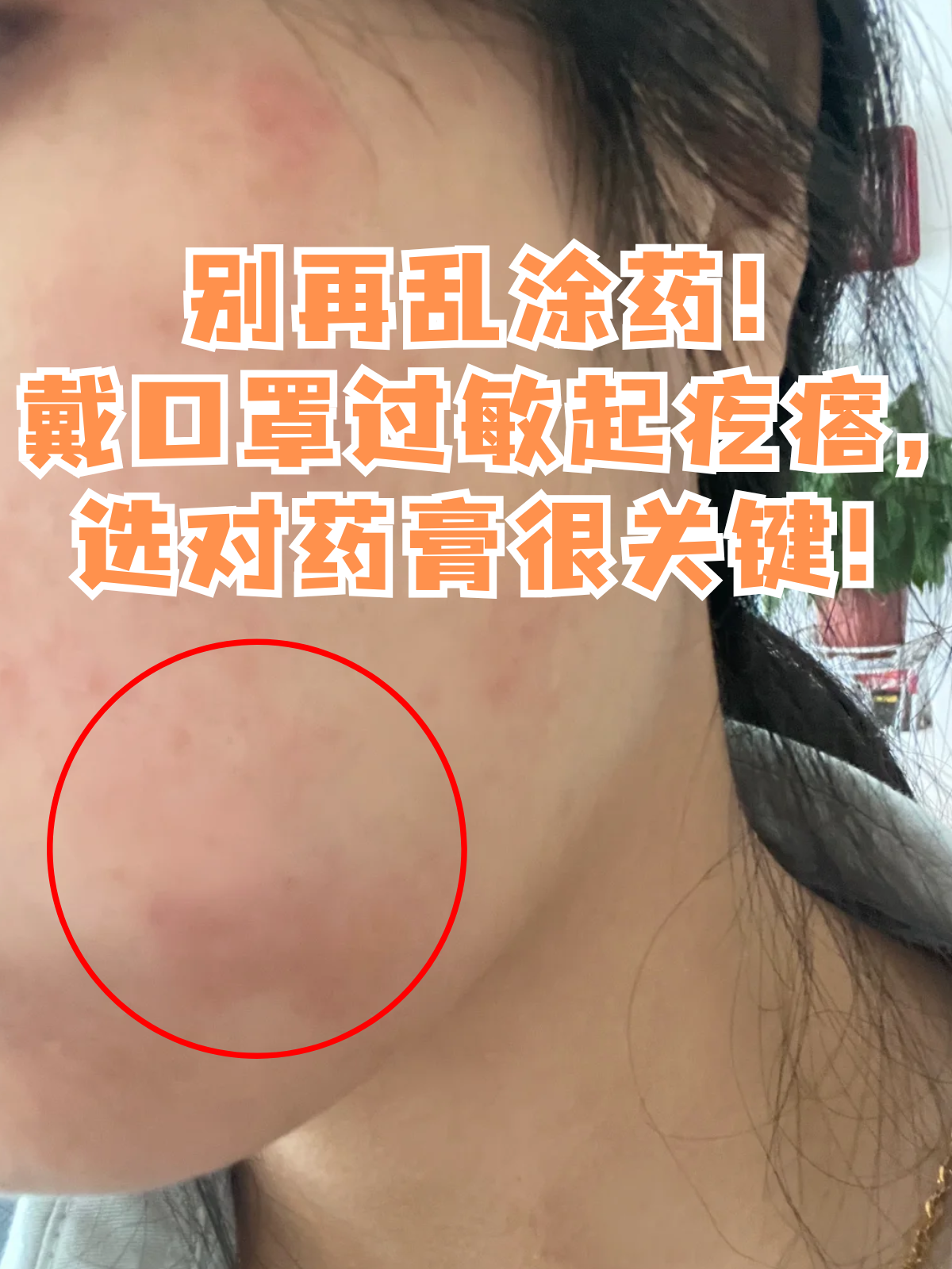 皮肤过敏起疙瘩怎么办