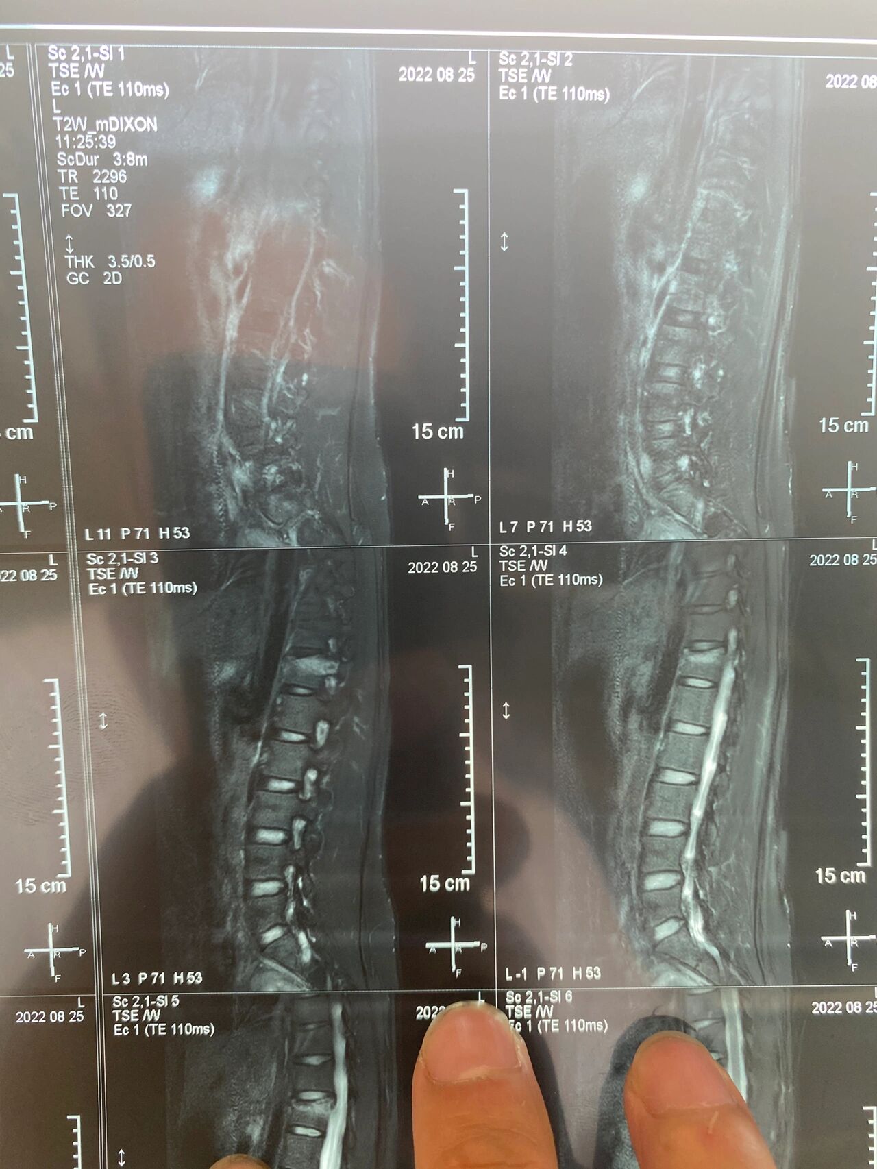 什么是腰椎压缩性骨折?