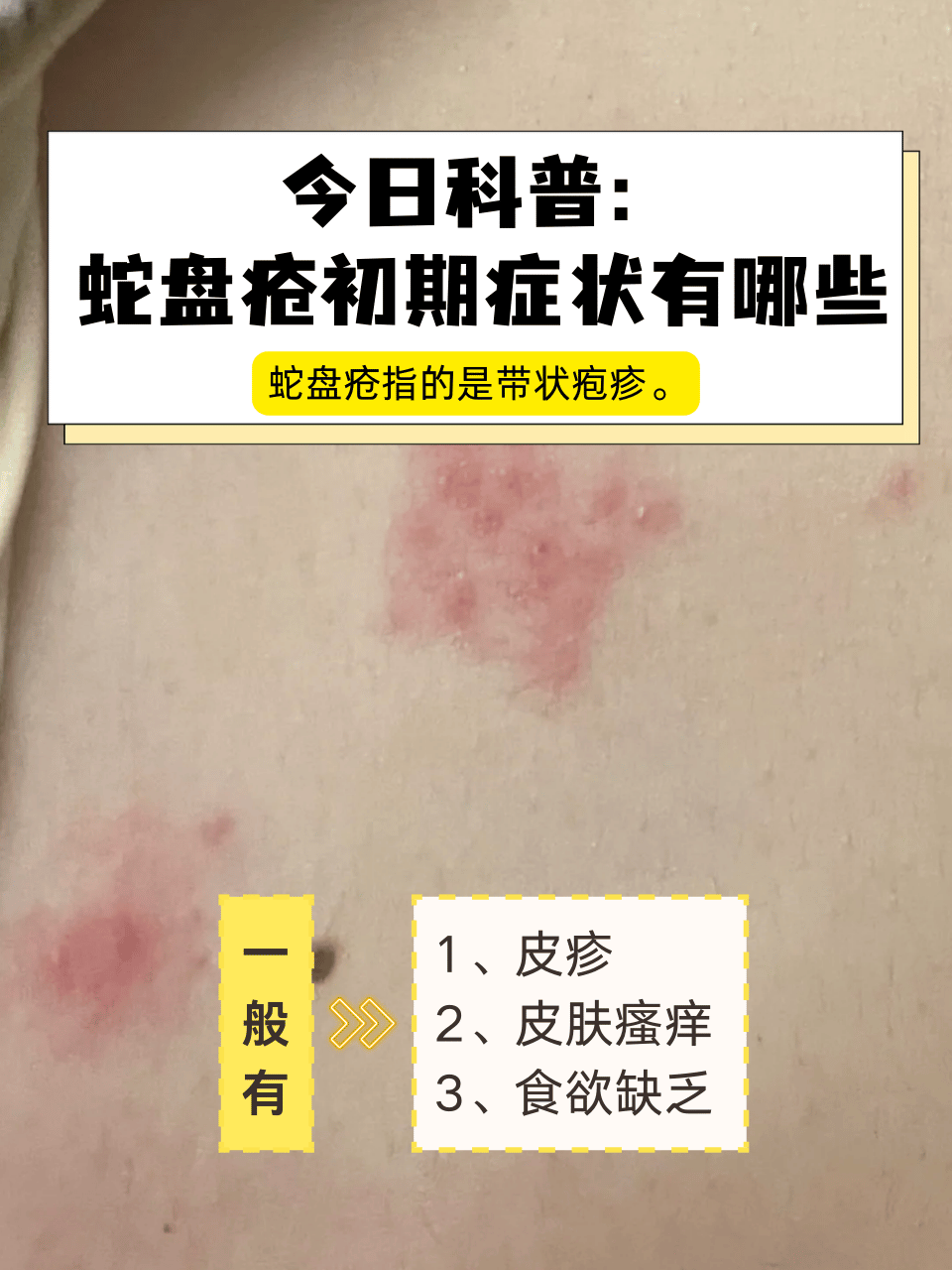 什么是带状疱疹?
