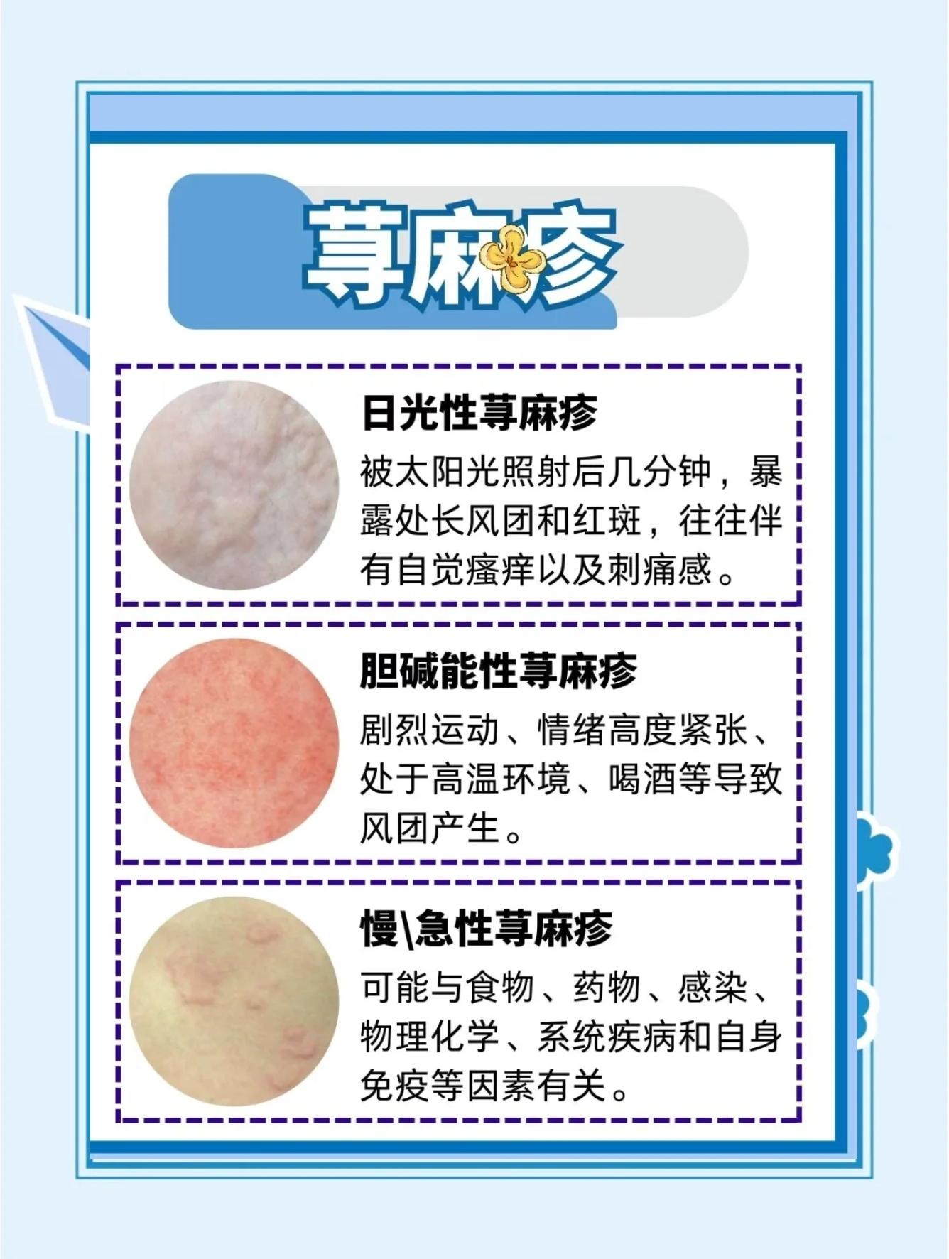 划痕性荨麻疹怎样治愈?