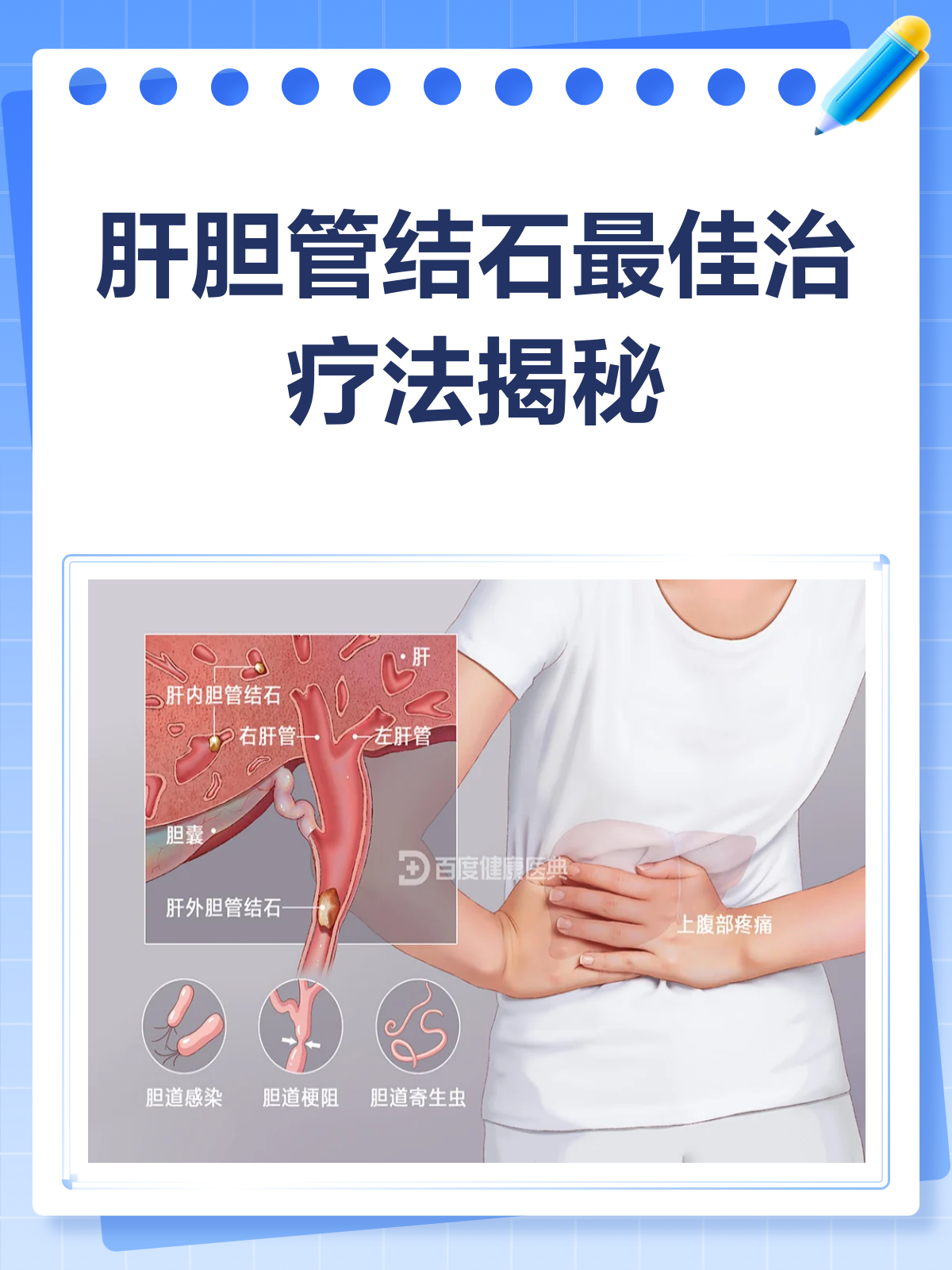 肝结石是怎样形成的?