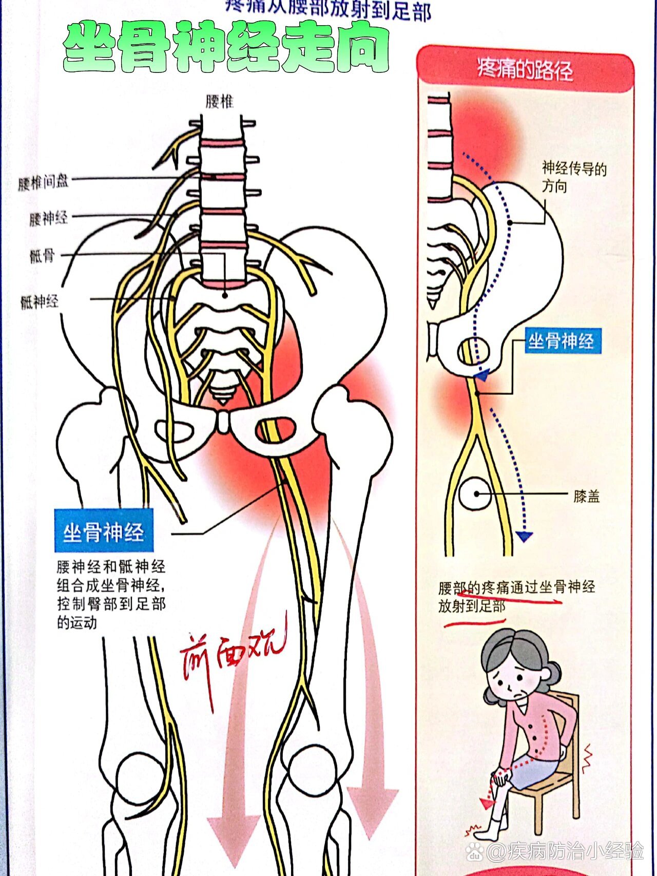 坐骨神经痛挂什么科