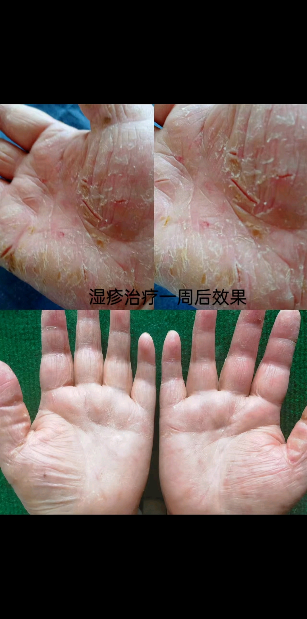 湿疹的治疗