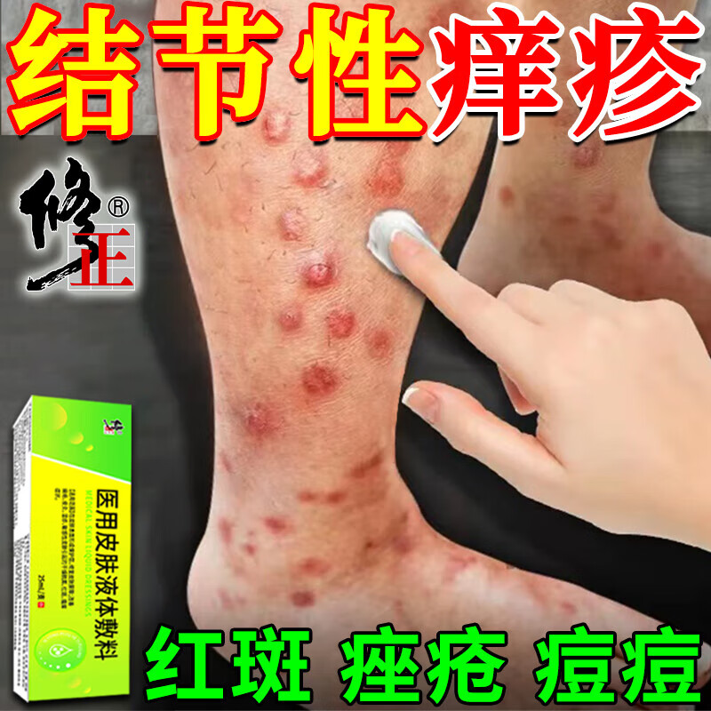 结节性红斑怎么治