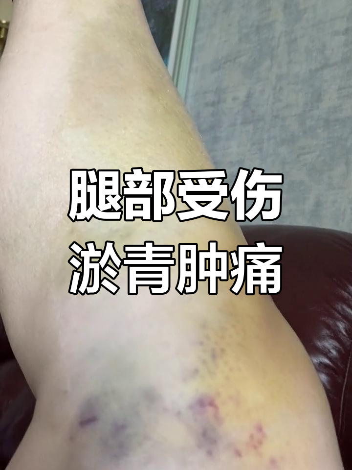 膝盖撞伤怎么处理