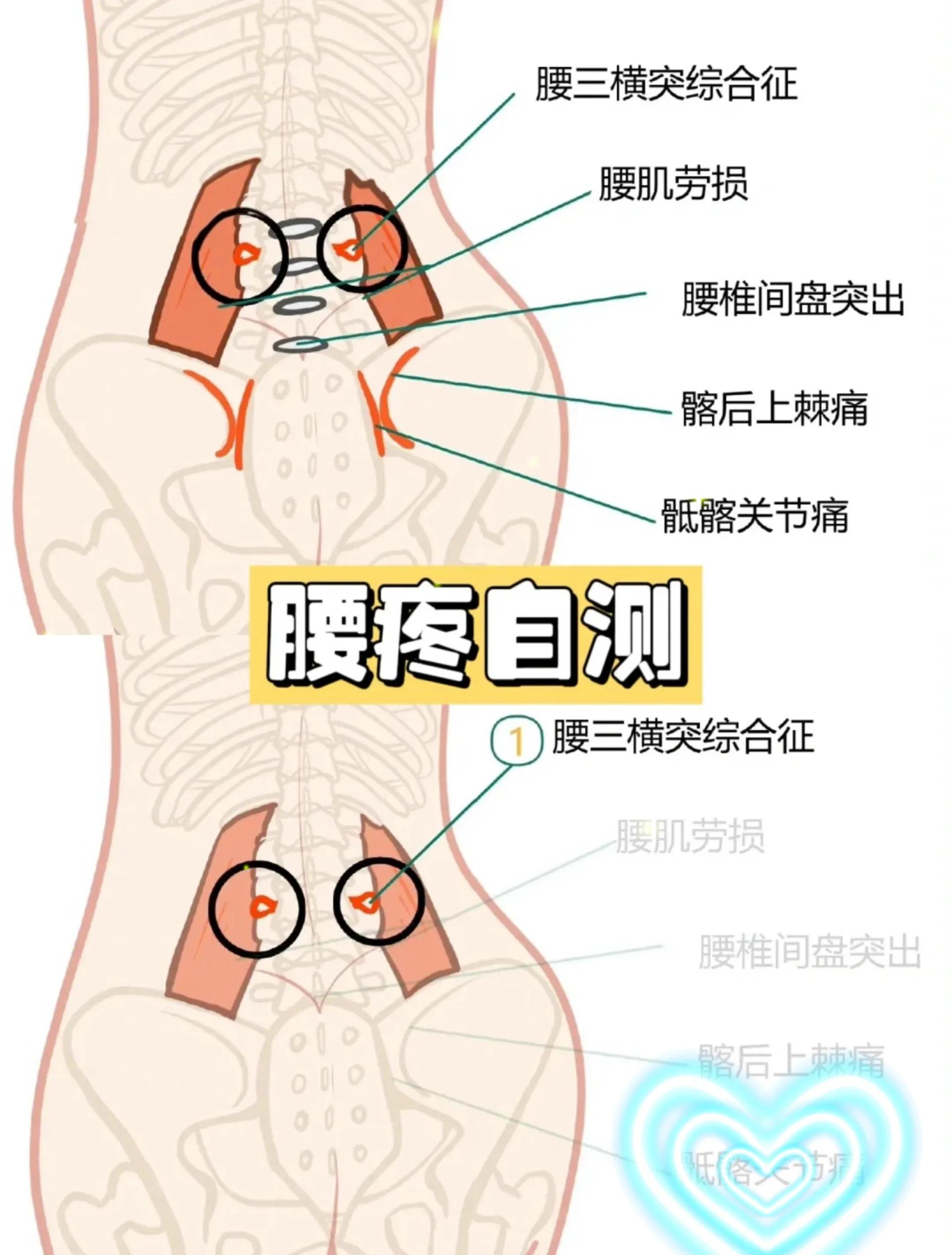 突然腰疼是什么原因引起的