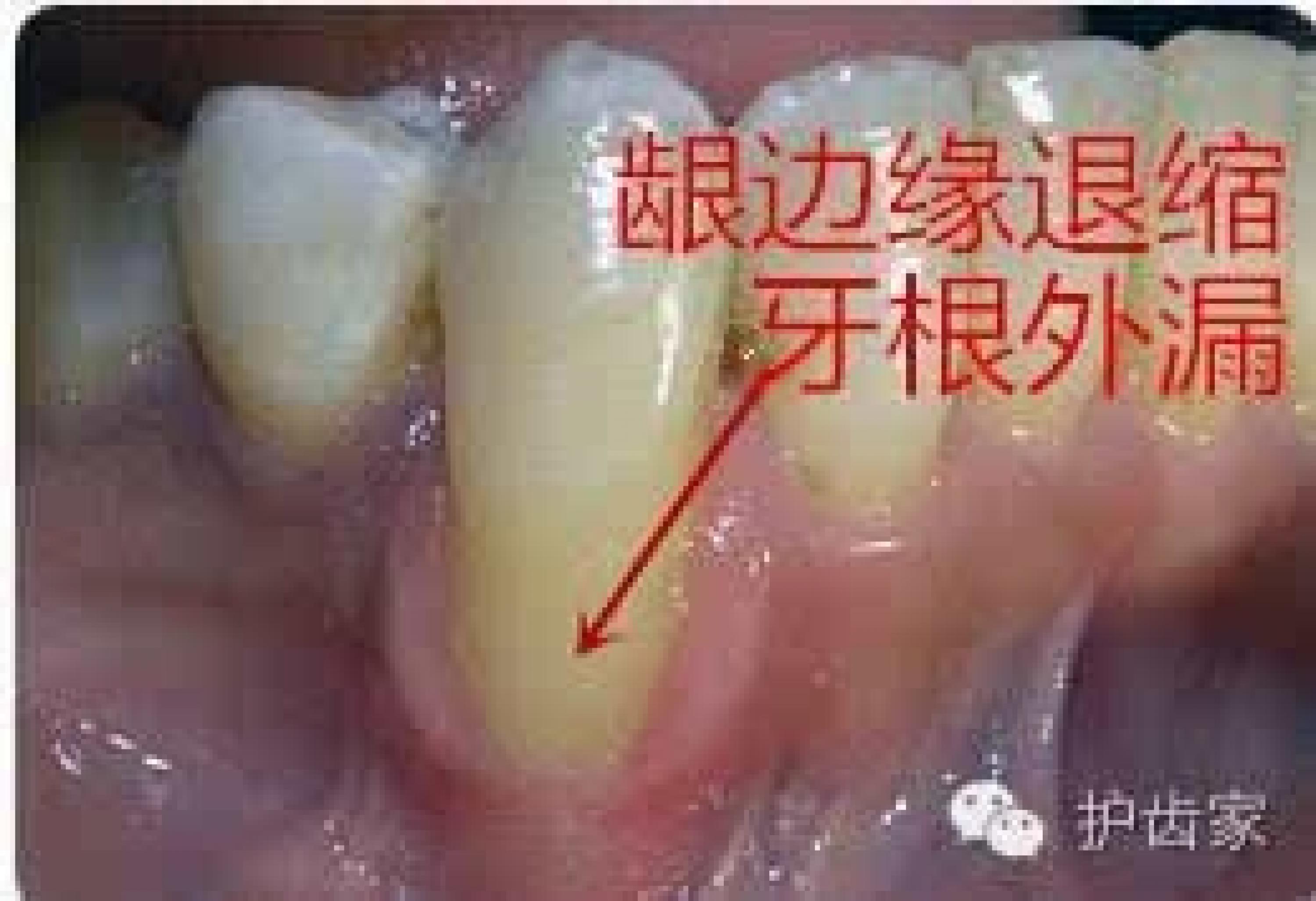 牙龈萎缩能长出来吗