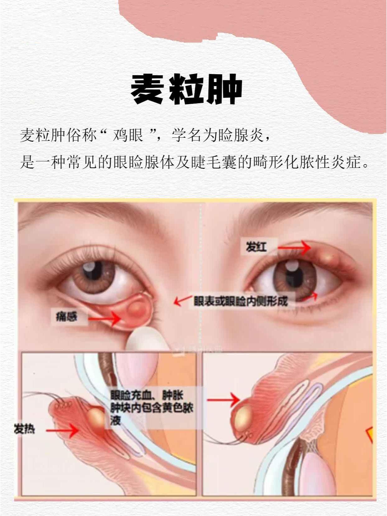 针眼怎么治
