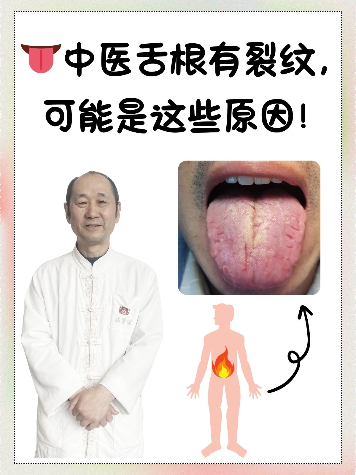 舌头上有裂纹怎么治