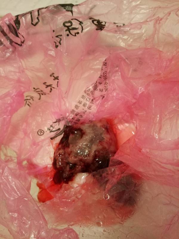 人流没做干净的症状