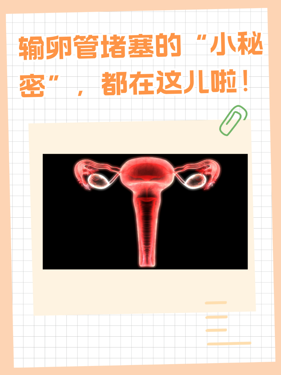 输卵管妊娠是怎么一回事?