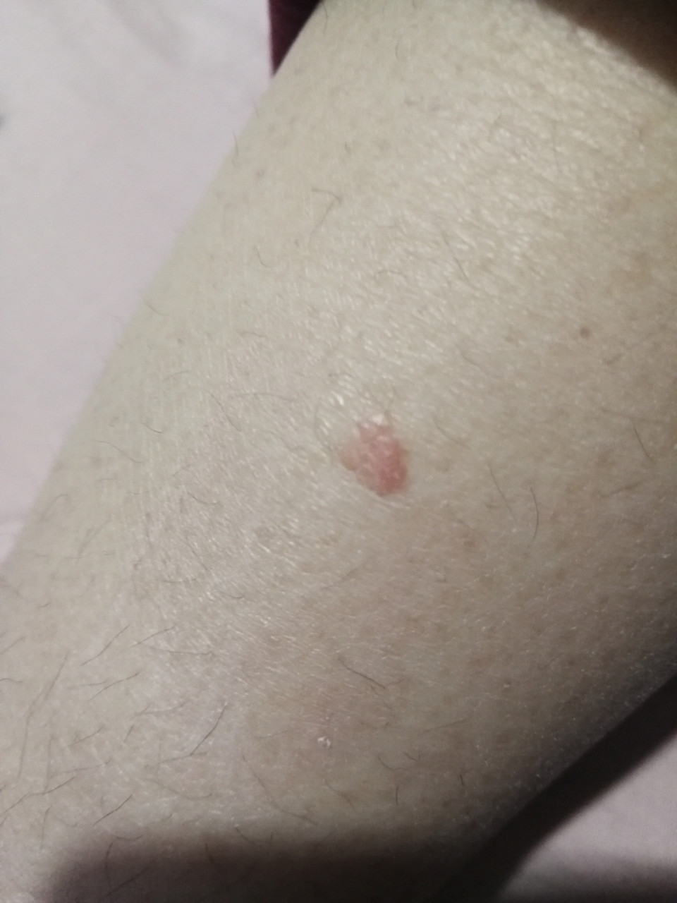 腿上长疙瘩