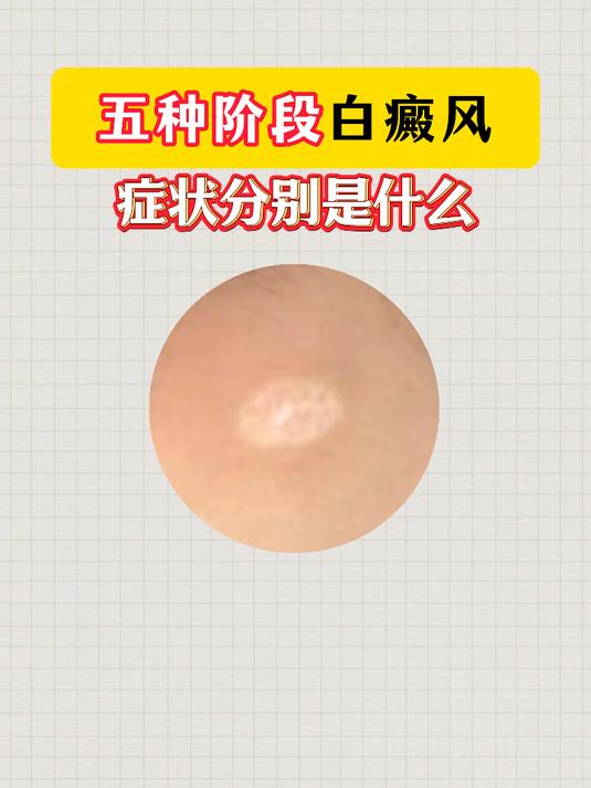 什么是白癜风