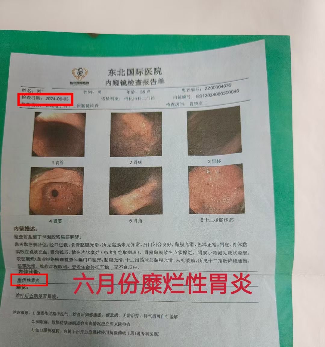 非萎缩性胃炎伴糜烂会严重吗?