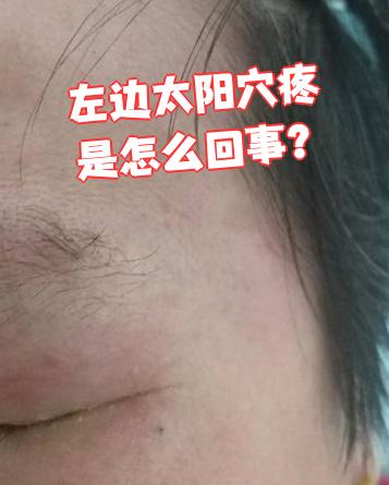 右边太阳穴这边一阵一阵的疼痛