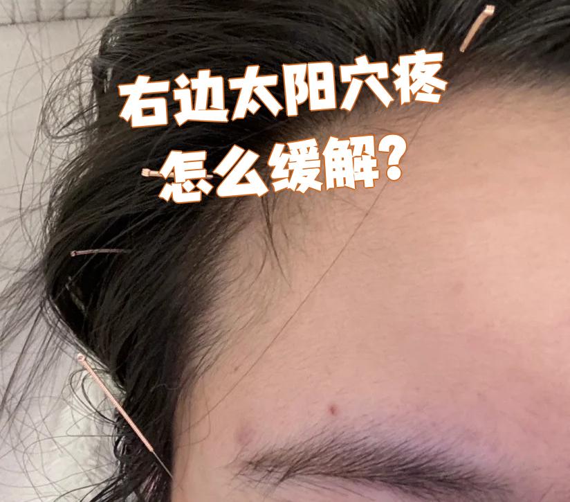 右边太阳穴这边一阵一阵的疼痛