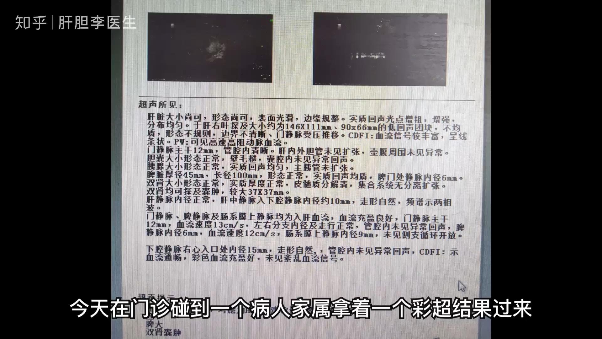 胆囊壁欠光滑是什么意思