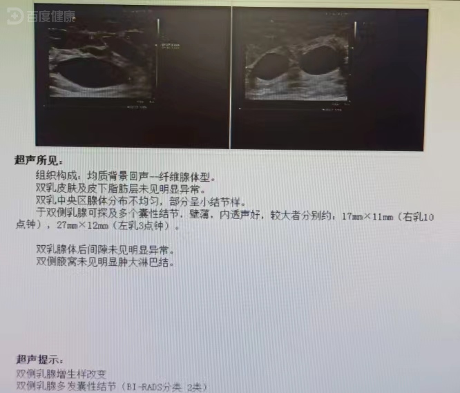 乳腺囊肿的治疗方法有哪些