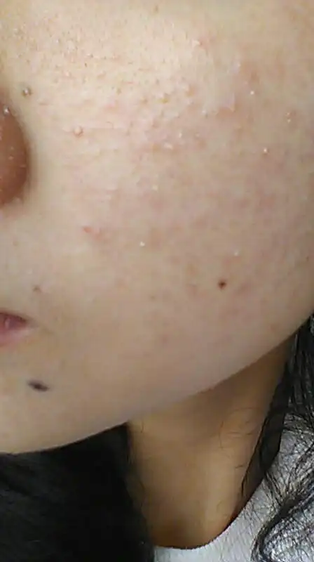脸部起了小疙瘩不疼不痒是什么