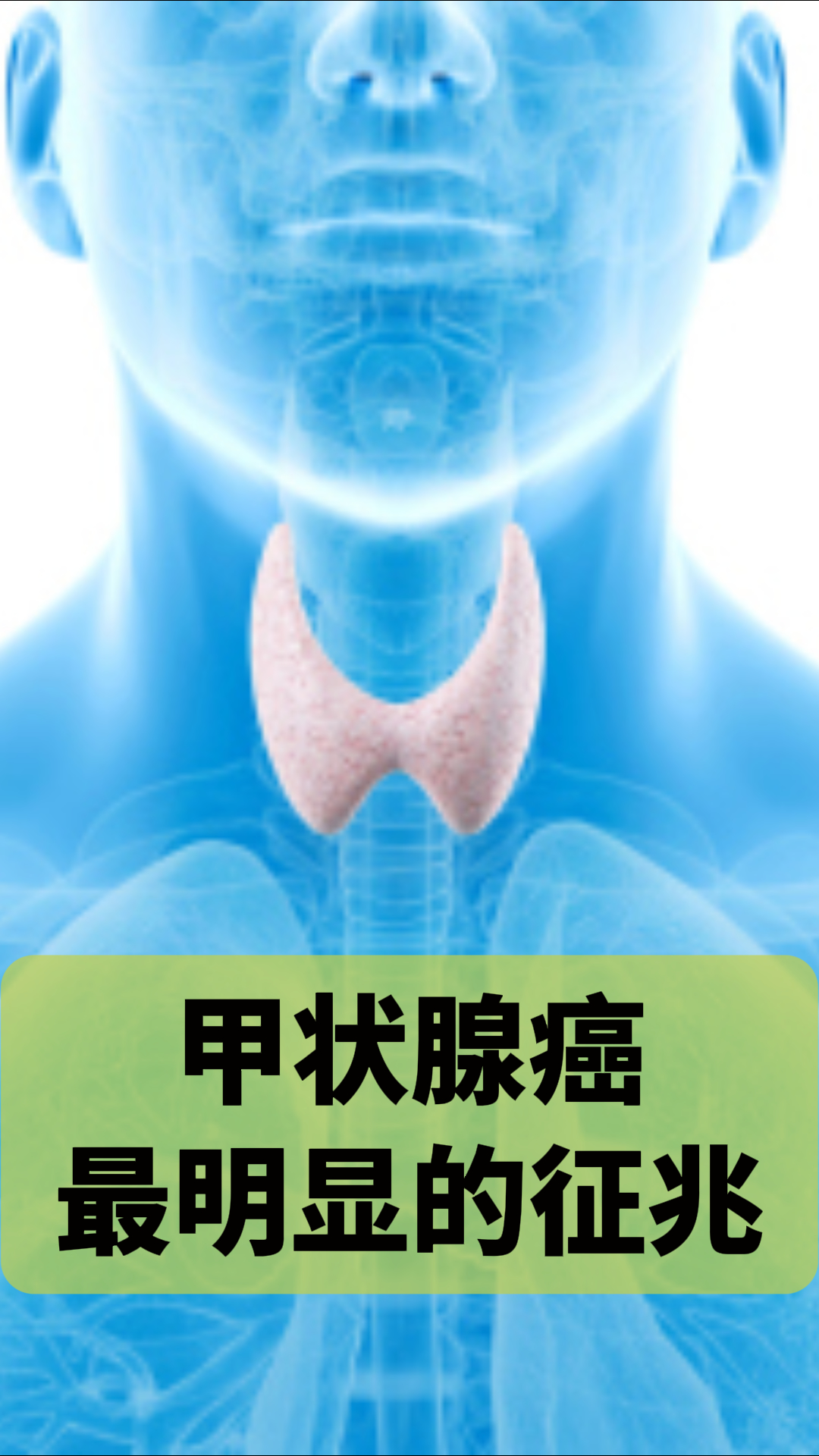 甲状腺癌有哪些前兆