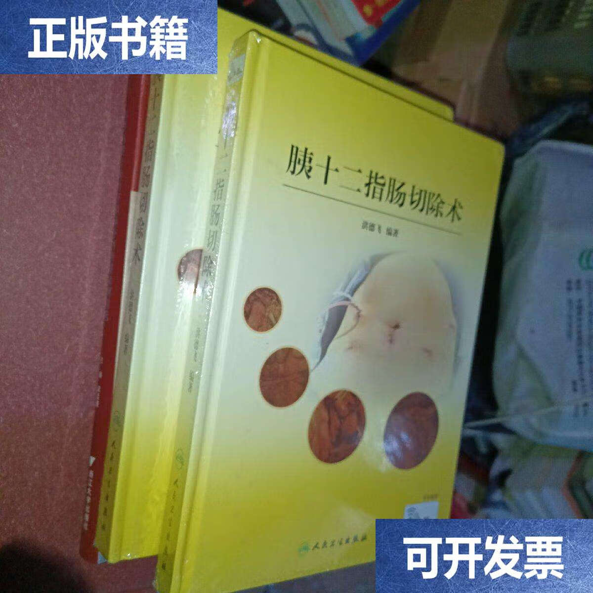 胰十二指肠切除术