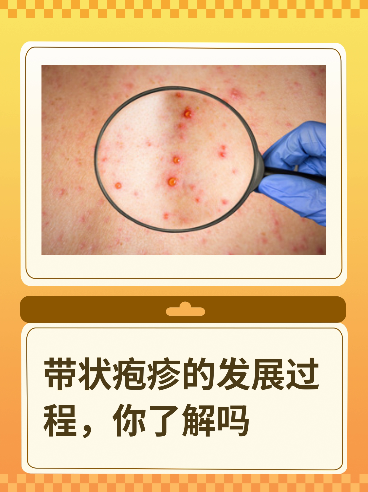 带状疱疹是怎么引起的?