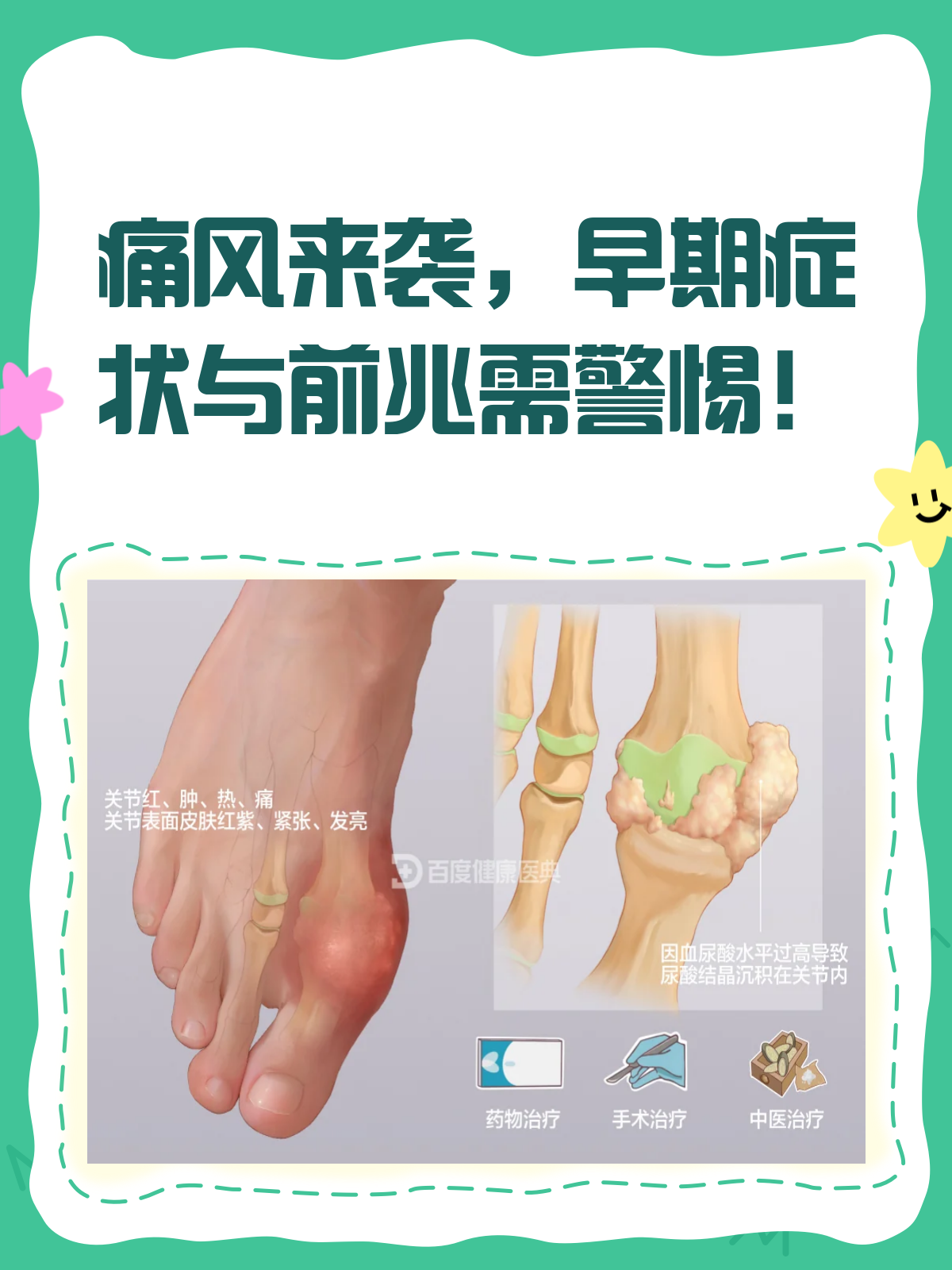 痛风发作前兆