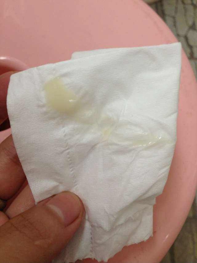 豆腐渣白带是怎么回事