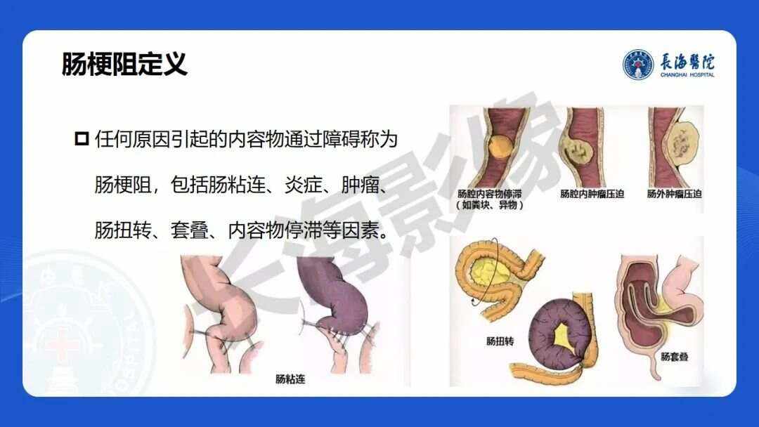 肠梗阻严重吗?