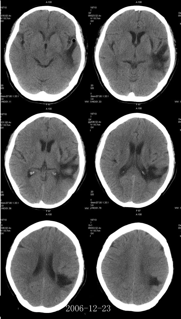 腔隙性脑梗塞能活多久