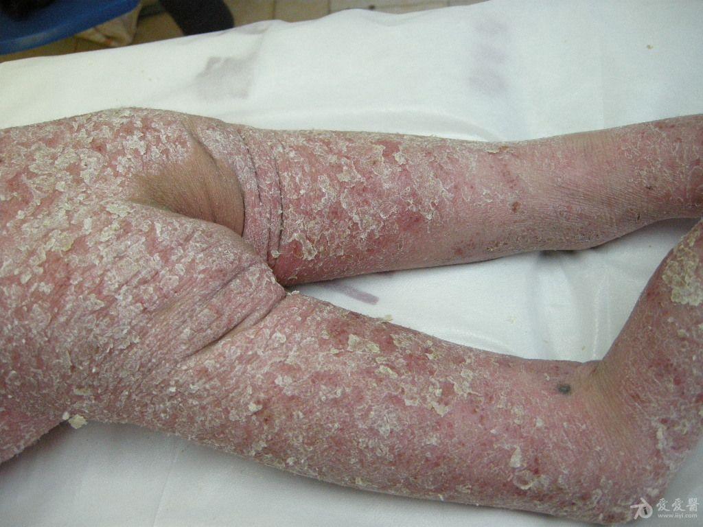 花柳病是什么症状