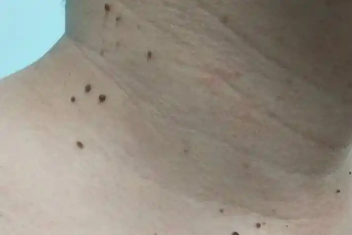 花柳病是什么症状