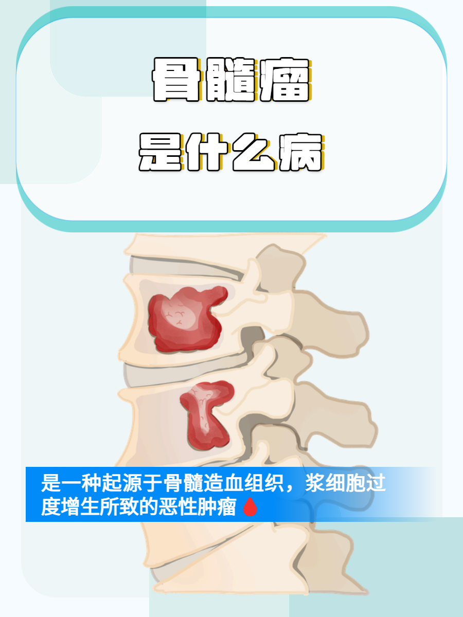 骨髓瘤细胞是癌细胞吗