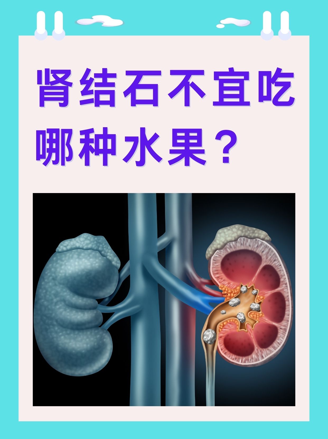 肾结石吃什么最好?