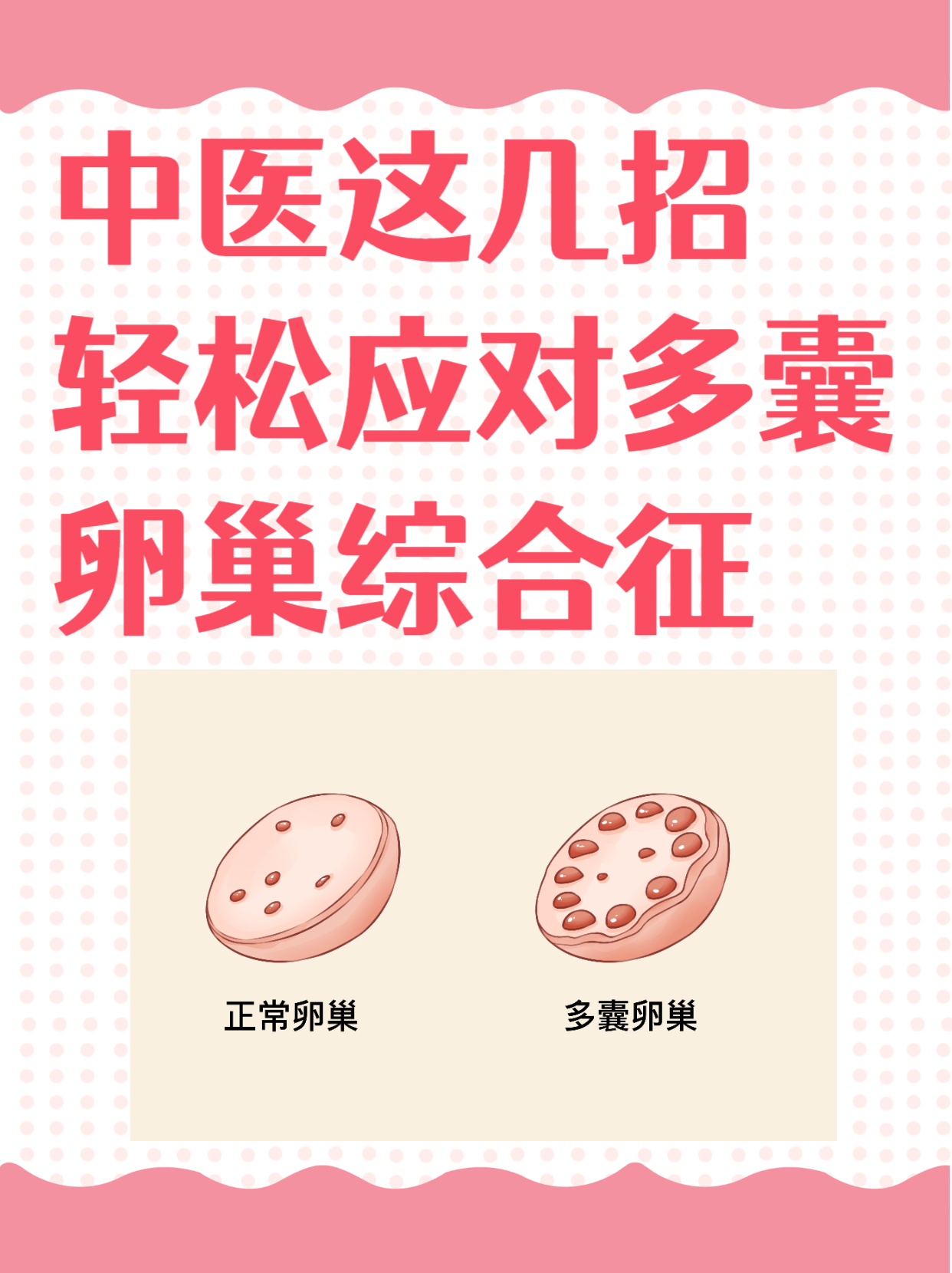 多囊卵巢可以自愈吗