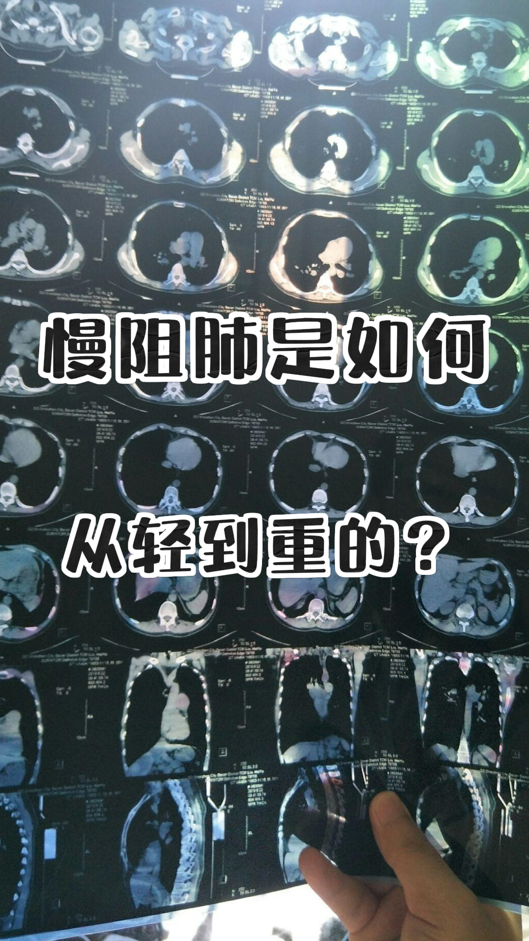 肺部有阴影什么病