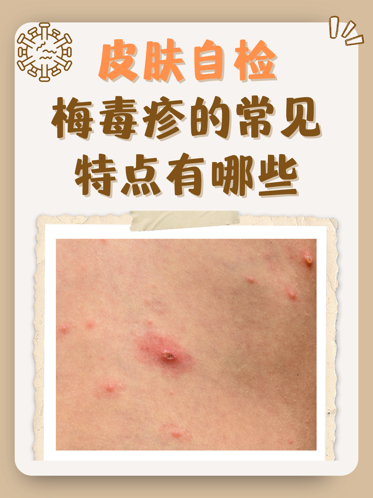 梅毒治愈后会复发吗