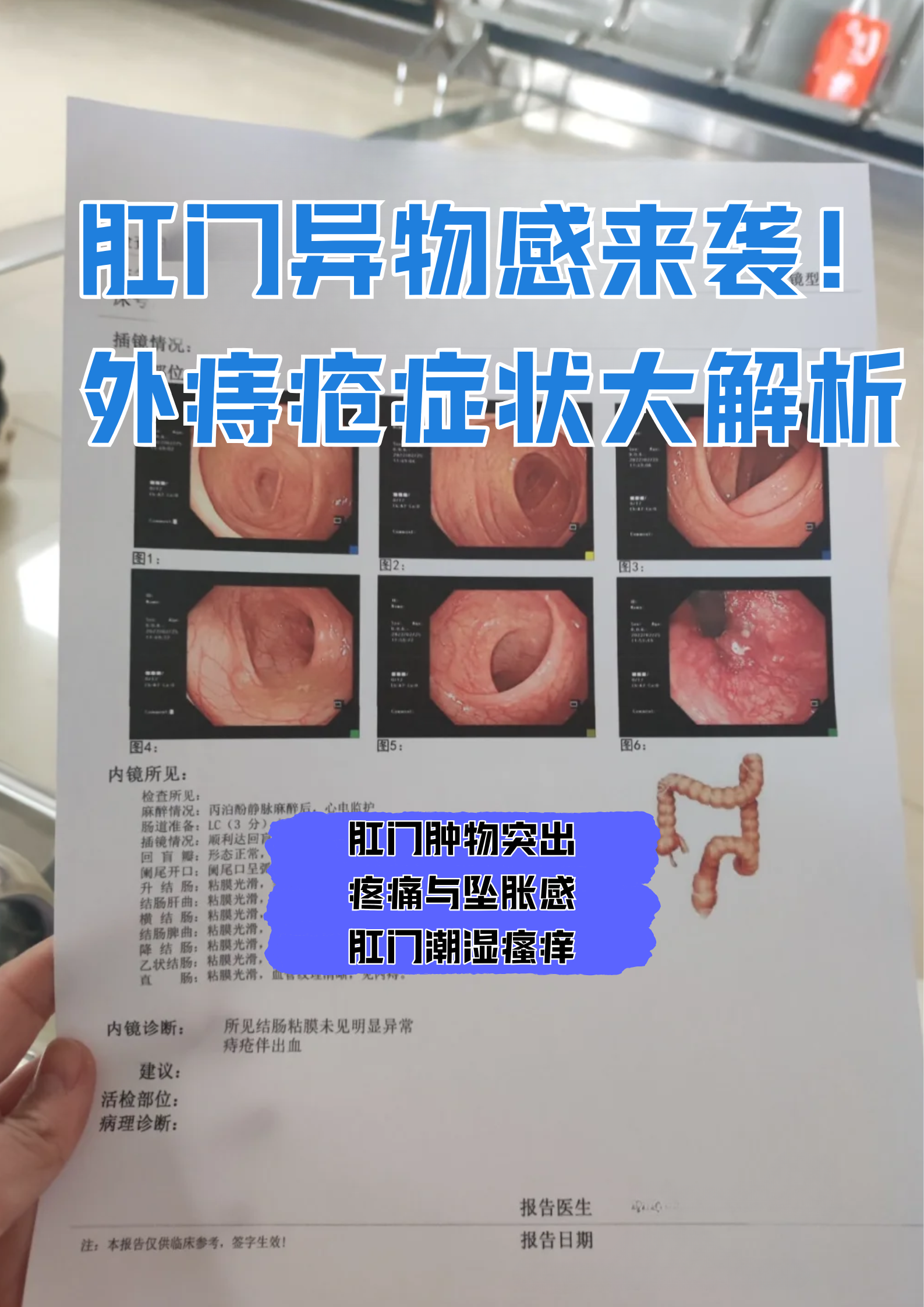 痔疮检查项目有哪些