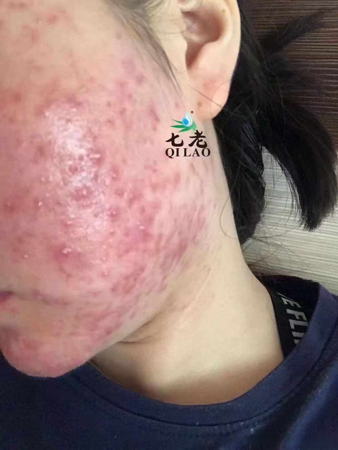 脸上长一片红痘痘很痒