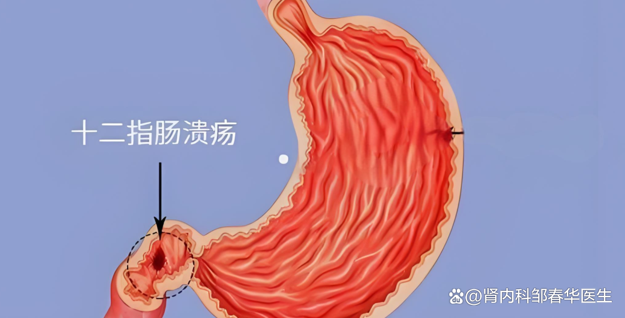 十二指肠溃疡多久能好
