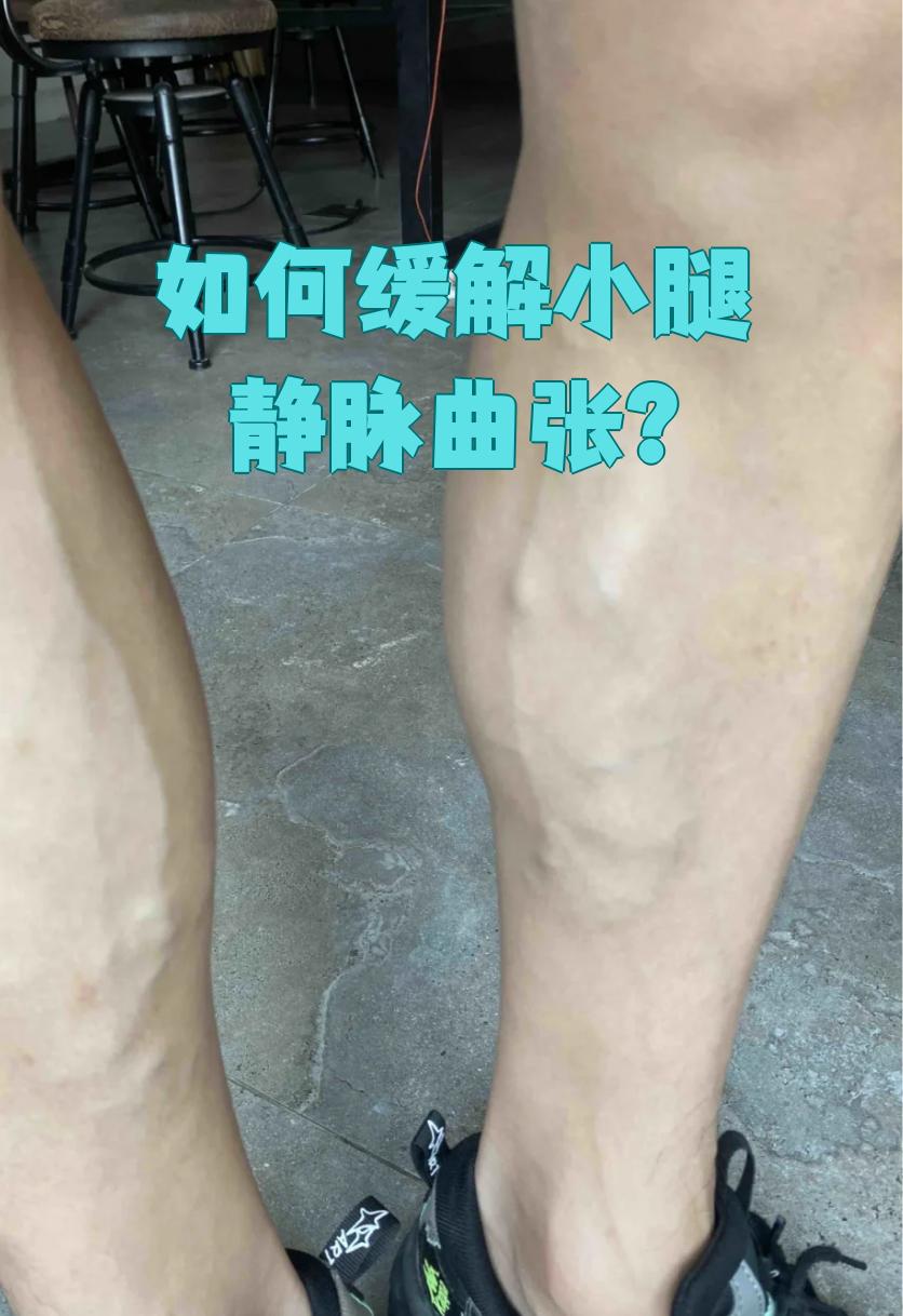 静脉曲张可以跑步吗