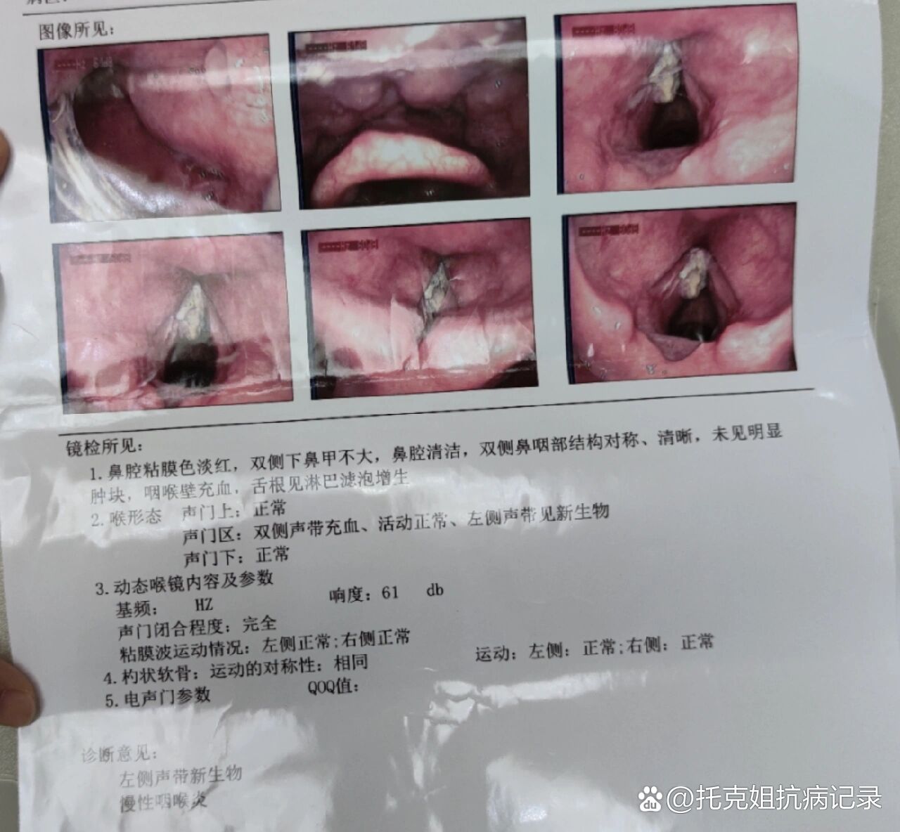 喉癌的初期表现?