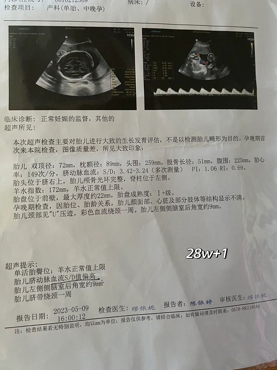 胎儿头大腿短是不是畸形