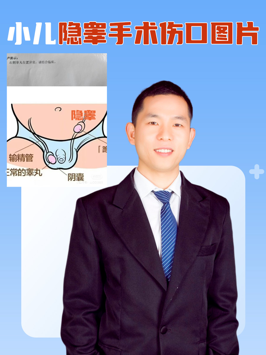 隐睾做手术
