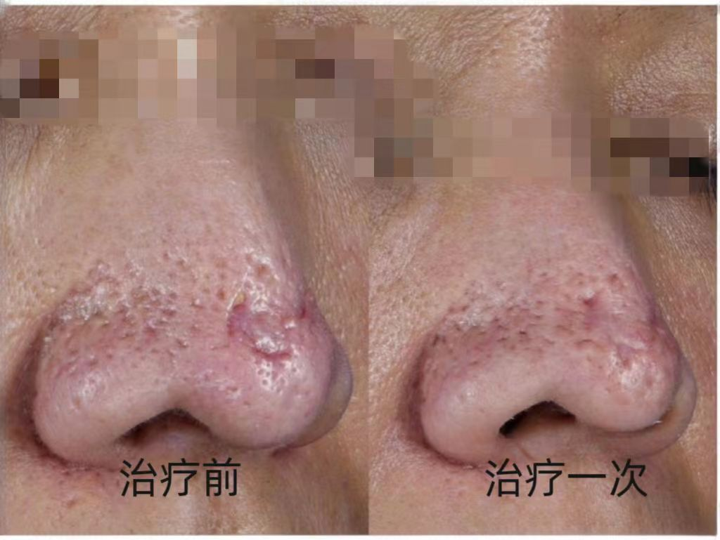 鼻翼两侧长粉刺是怎么回事