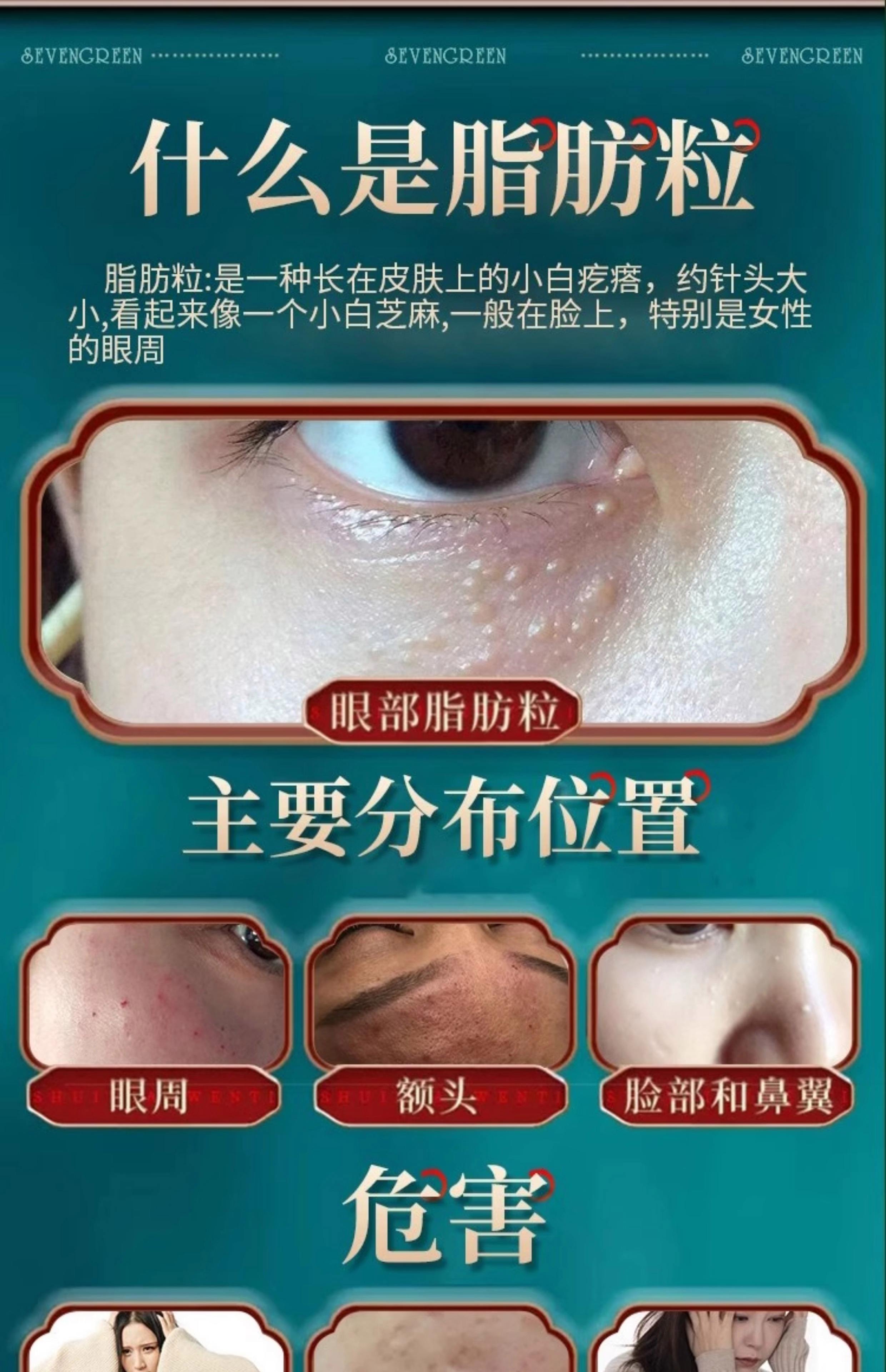 眼睛周围长脂肪粒是什么原因